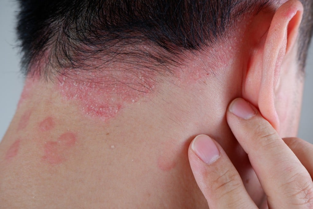 It can be difficult for the untrained eye to tell the difference between mild eczema and psoriasis (above). Photo: Shutterstock