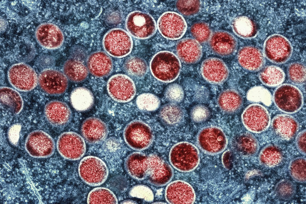 WHO began consulting experts about renaming the disease in August, shortly after the UN agency declared monkeypox’s spread to be a global emergency. Photo: AP
