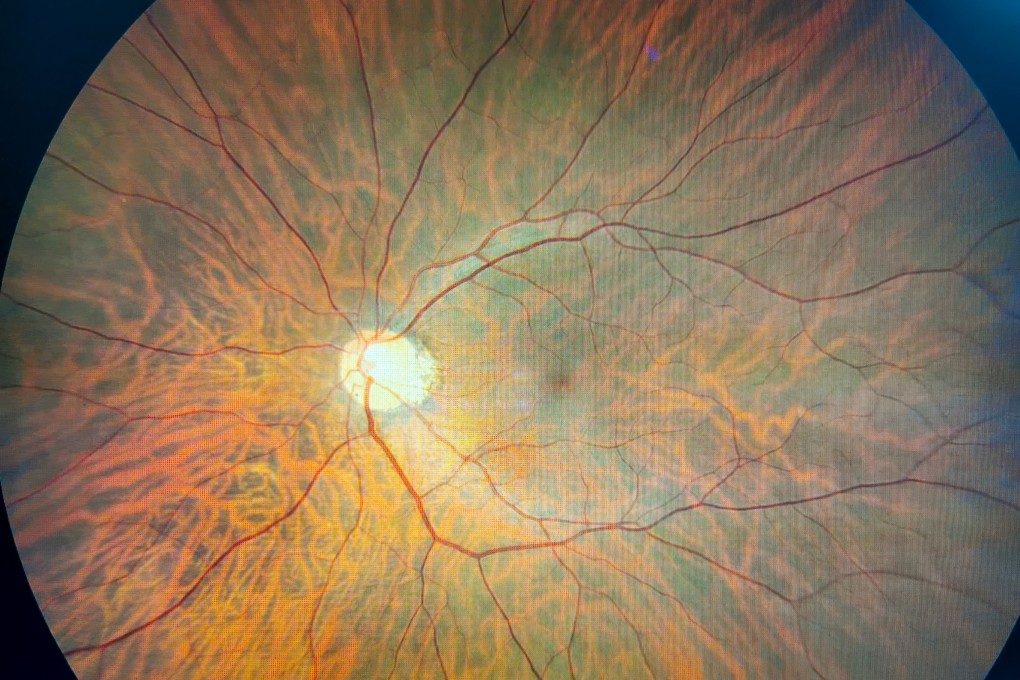 Hong Kong scientists have developed an artificial intelligence model that can screen for Alzheimer’s disease by reading a patient’s retina images. Photo: Shutterstock
