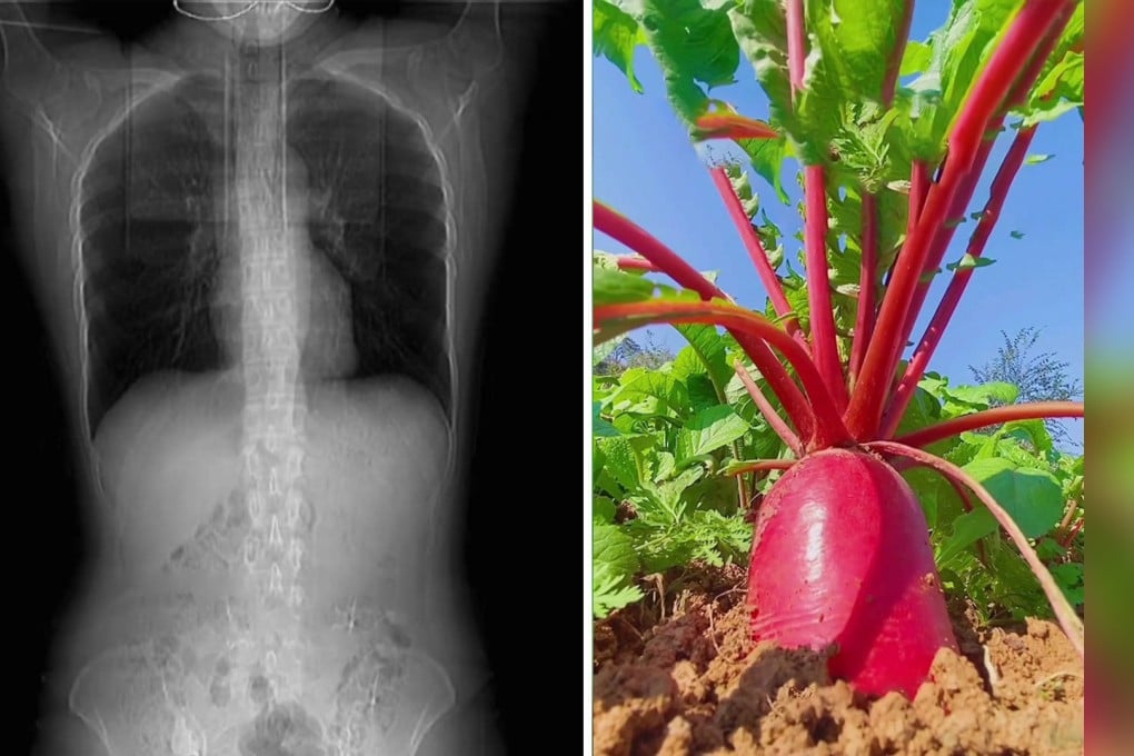 A woman has a coughing fit from spicy food that breaks four ribs and radish thieves get caught by police while preparing to eat the produce. Photo: SCMP composite/handout