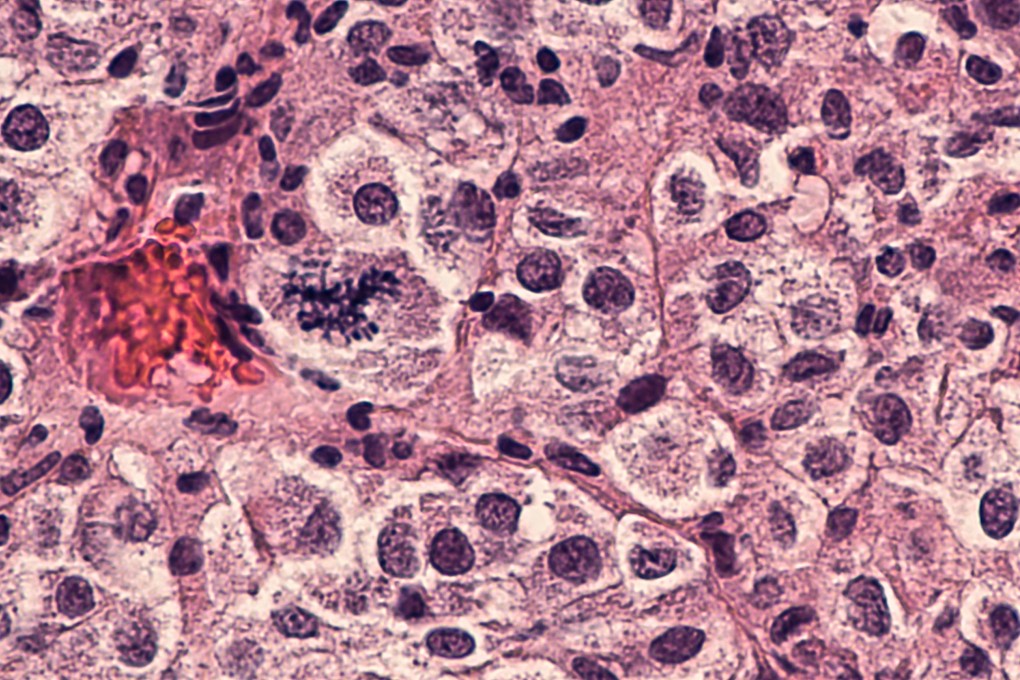 Data from Moderna and Merck skin cancer Phase 2 trials shows an “extremely strong result” for a personalised cancer vaccine. Photo: Shutterstock Images