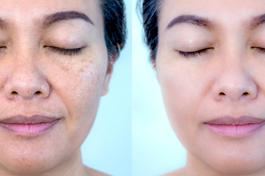 Skin lightening products are popular, but may contain harmful ingredients such as mercury. Choose a safe alternative instead, such as medically supervised peels to lighten dark spots on your skin. Photo: Shutterstock