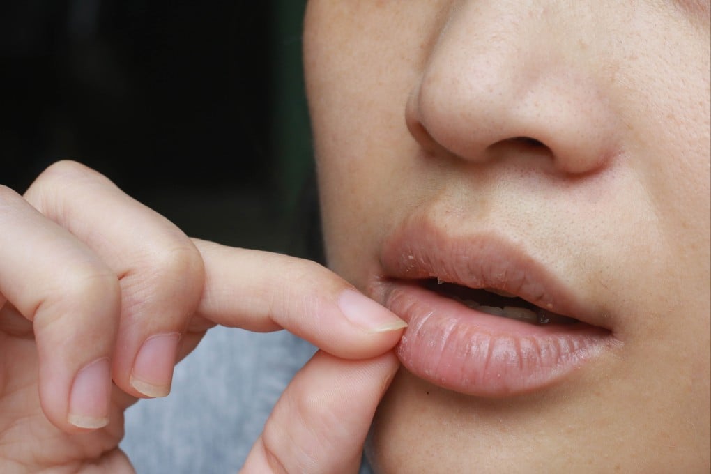There are many things that can cause dry, cracked or tight-feeling lips, including dehydration, sun burn, yeast infection and vitamin deficiencies. Photo: Shutterstock
