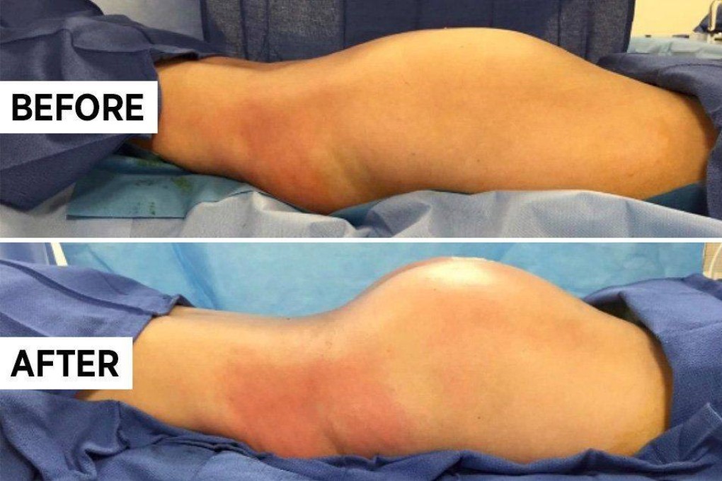 The before and after of the Brazilian butt lift. While it is one of the most popular plastic surgery procedures in the world, it is also the deadliest.