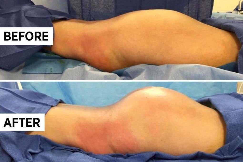 The before and after of the Brazilian butt lift. While it is one of the most popular plastic surgery procedures in the world, it is also the deadliest.