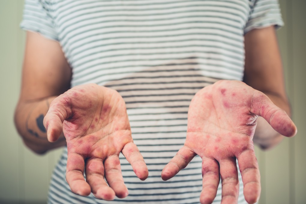 Authorities report an upwards trend in cases of children suffering from hand, foot and mouth disease. Photo: Shutterstock