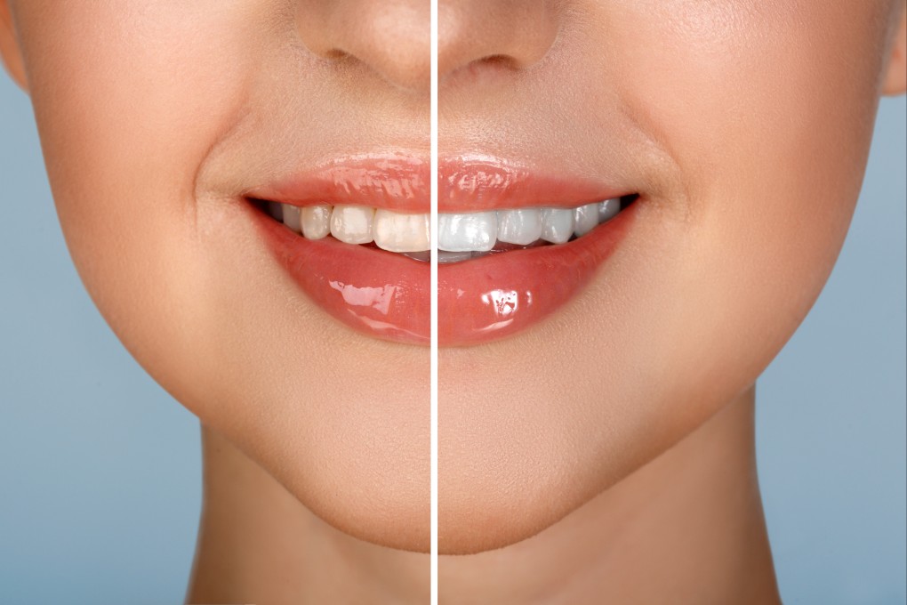 With so many teeth whitening methods out there, we enlist expert help to find the ones that work, and where to get the best professional results. Photo: Shutterstock
