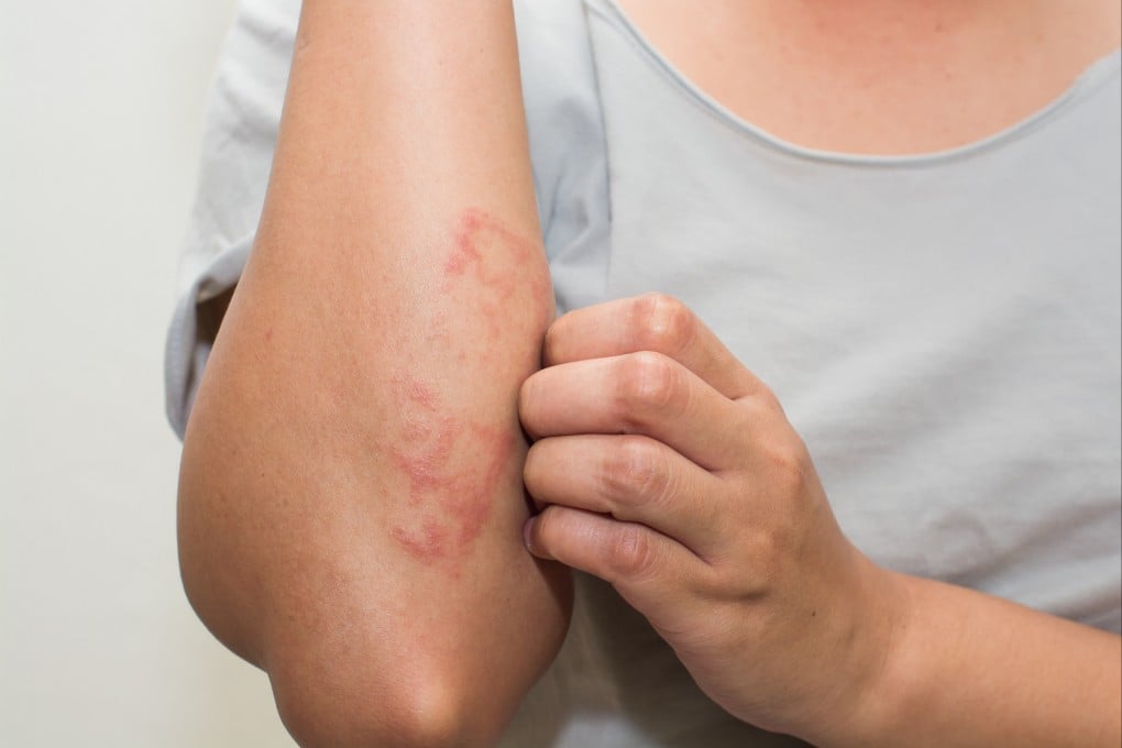 Eczema is a chronic non-contagious inflammatory skin condition, characterised by severely dry, itchy skin. Photo: Shutterstock