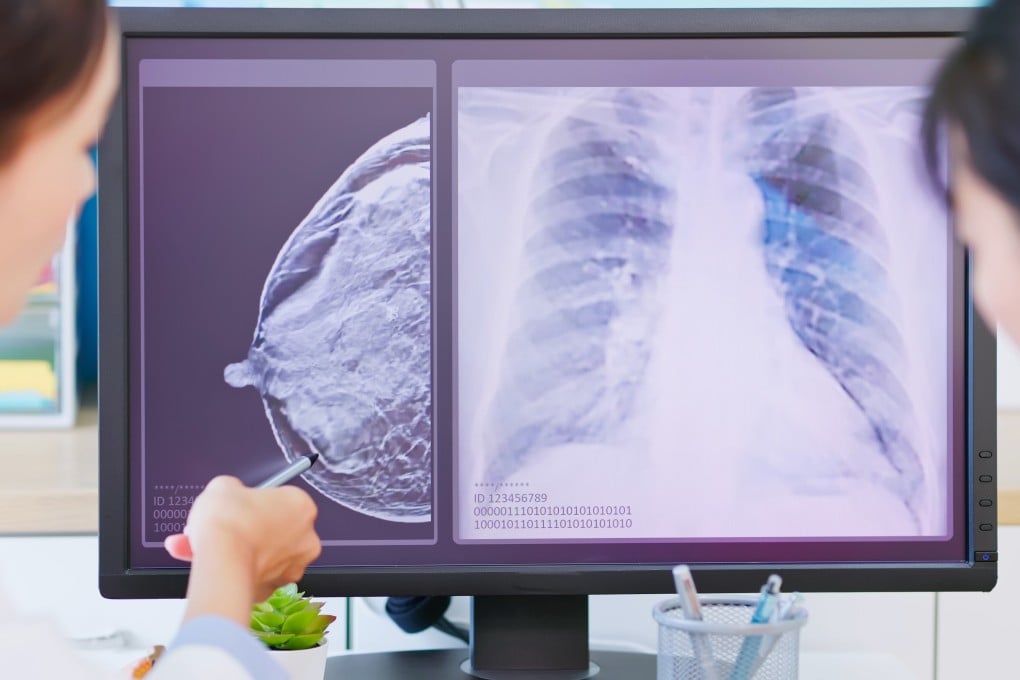 In the future, cancer detection will have the highest impact in the fight against the disease, while treatment will have the least, Dr Siddhartha Mukherjee says. Photo: Shutterstock