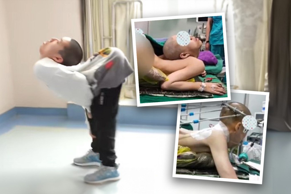 A 19-year-old student who has been dubbed China’s “folded boy” has taken the first surgical step on a journey he hopes will end with him being able to stand up straight. Photo: SCMP composite/xhby.net