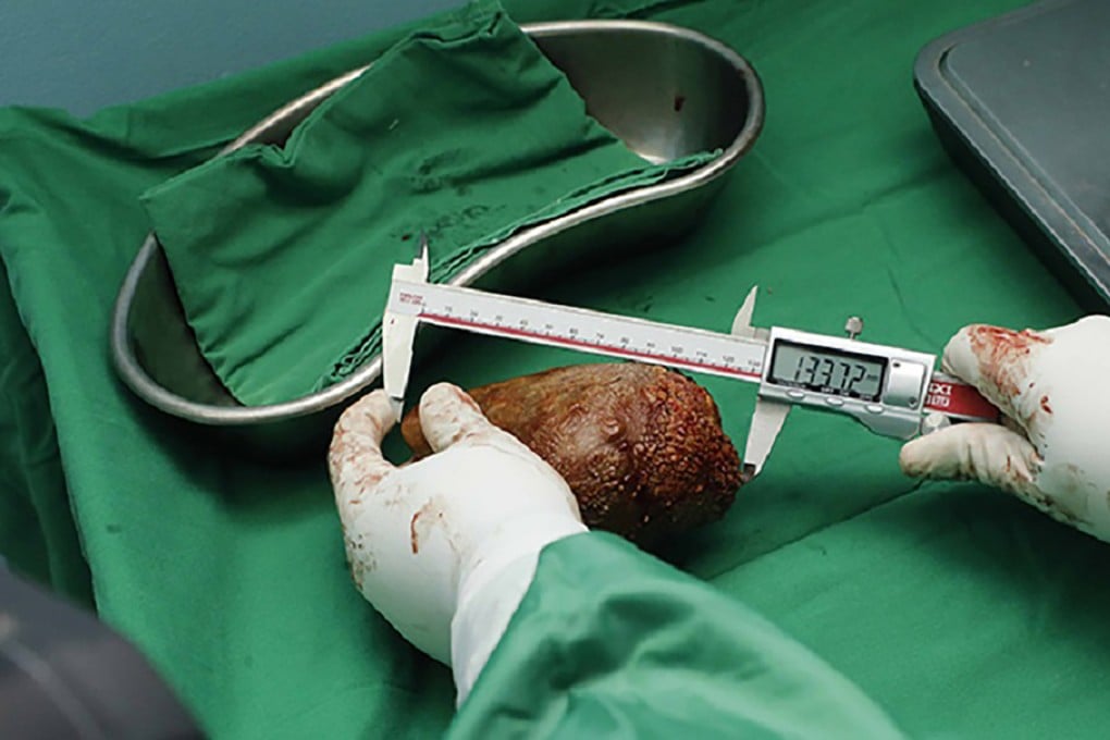Military doctors in Colombo have removed what has been recorded as the world’s largest kidney stone from a retired soldier. It was 13.37cm long, compared to the average kidney, which is about 10-12cm long. Photo: Sri Lanka Army