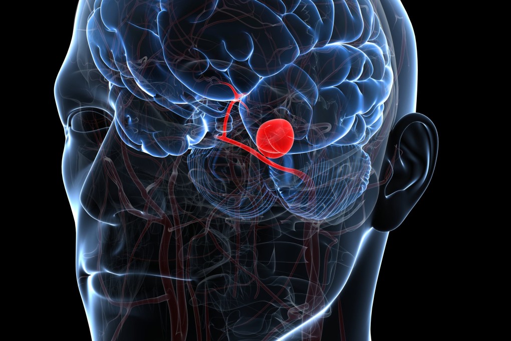 A brain aneurysm occurs when there is a bulge in a weak area of an artery in the brain. A ruptured aneurysm can also cause people to experience extremely painful headaches, nausea, vomiting, stiff neck, blurry vision or a serious loss of consciousness. Photo: Getty Images