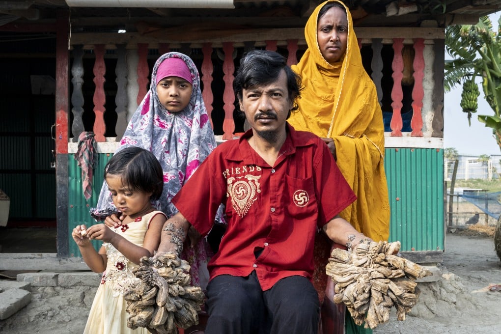 Abul Bajandar with his wife, Halima Khatun, and their daughters Jannatul (10) and Shayera (two). Bajandar, known as Bangladesh’s “Tree Man”, suffers from an extremely rare condition that sees gigantic warts cover his hands and feet. Photo: Miguel Candela