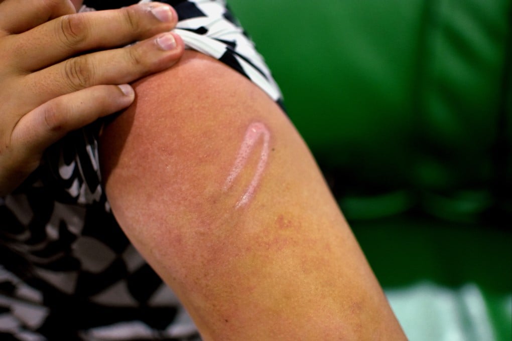 A trafficking victim shows the scars left by the Myanmar scam gangs’ beatings. Photo: Alastair McCready