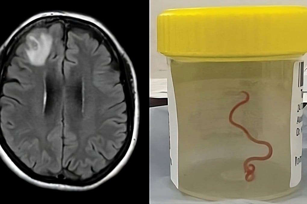 A combination image shows a magnetic resonance image of the patient’s brain with the frontal lobe lesion (left); and the 8cm long Ophidascaris robertsi worm (right) that was removed. Photo: Emerging Infectious Diseases/Handout