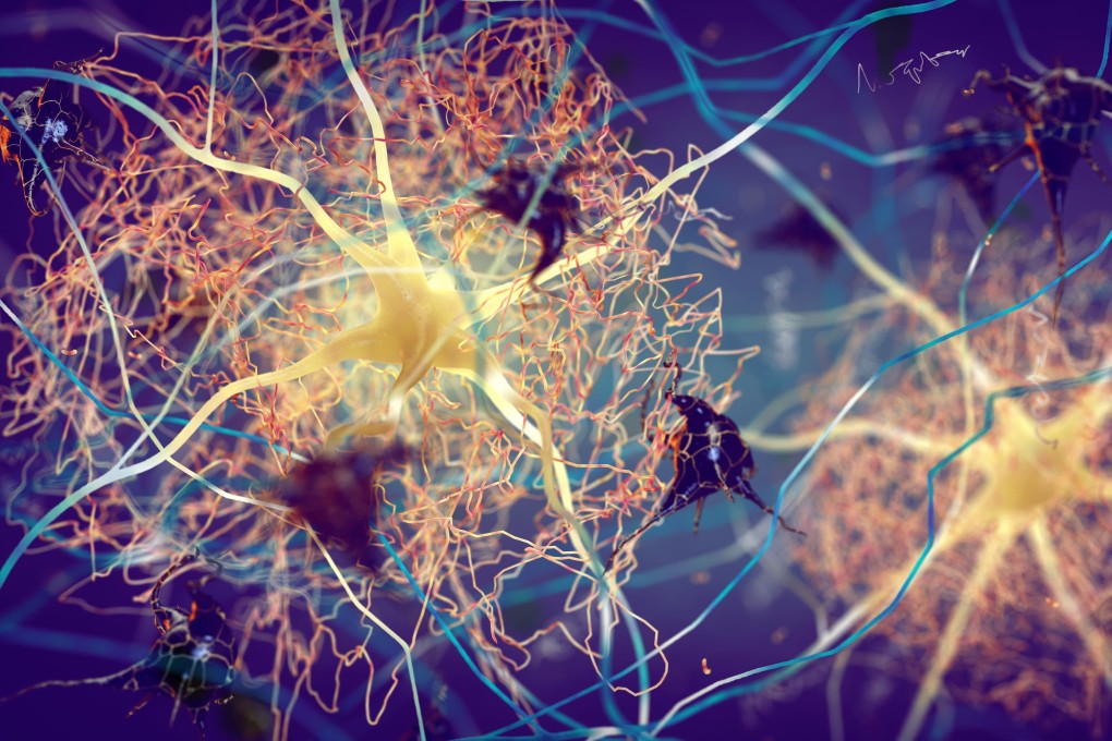 Amyloid plaques and tau tangles found in Alzheimer’s sufferers’ brains are caused by build-ups of proteins that block electrical messages. 
Photo: Shutterstock
