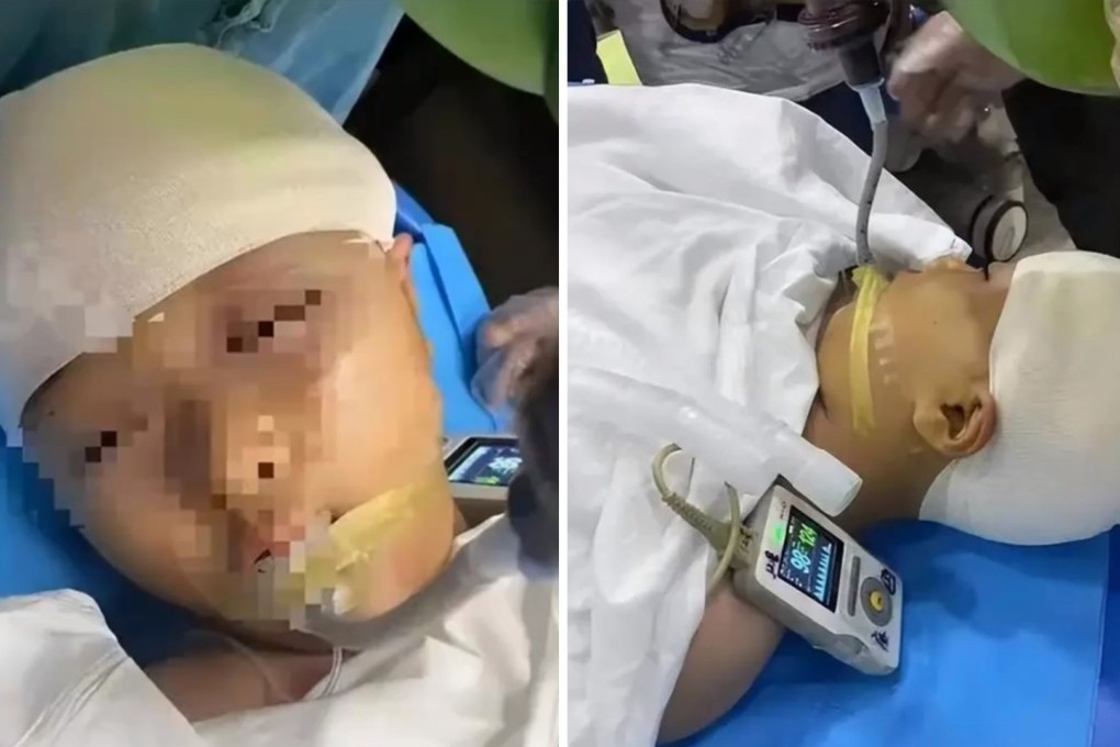 Tests revealed the girl’s skull was fractured and bone fragments were lodged in her head, requiring almost five hours of emergency surgery. Photo: SCMP composite/Baidu
