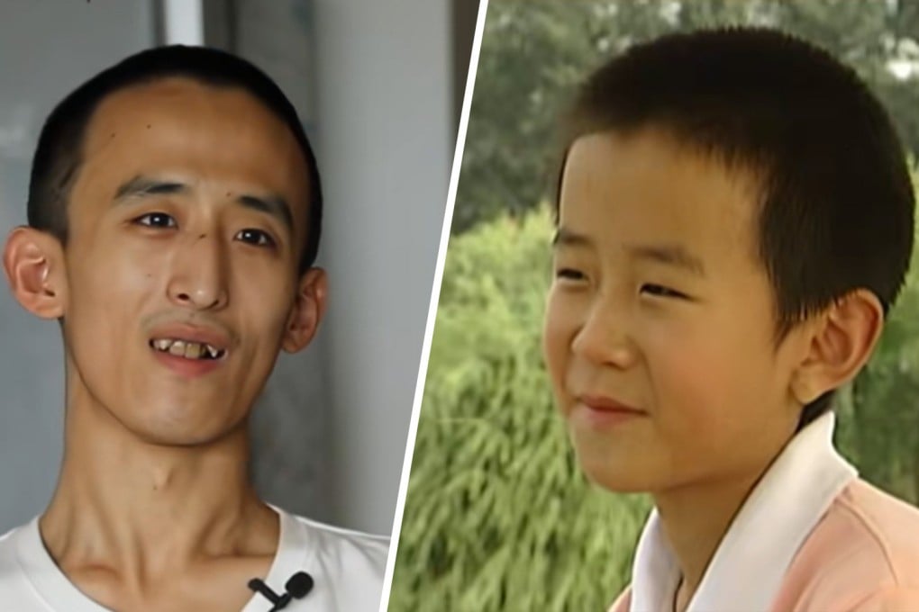 Zhang Xinyang, 28, a Chinese prodigy who won a university place at age 10, now believes “sitting around and doing nothing is the key to lifelong happiness”. Photo: SCMP composite/Douyin