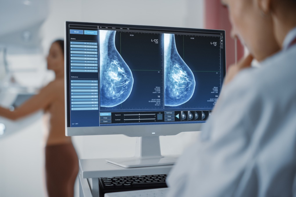 Mammograms are a more reliable tool than self-identification to detect early-stage breast cancer. In Breast Cancer Awareness Month, a survivor and a doctor tell the Post why they think women above a certain age should have one regularly. Photo: Shutterstock