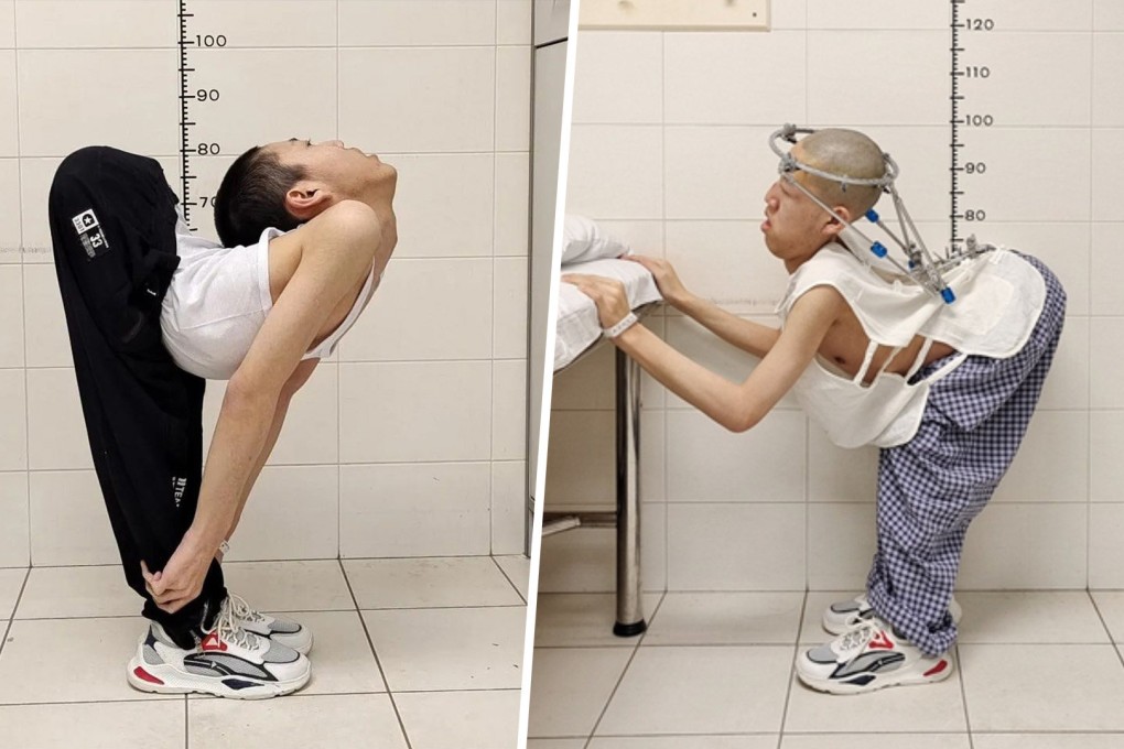 An inspirational 19-year-old student in China who is widely known as the “folded boy” has undergone successful surgery in an important new step on the long journey to being able to stand up straight. Photo: SCMP composite/Peking University