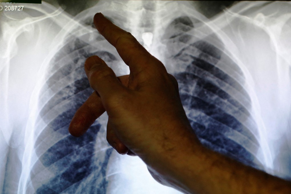 A doctor points to an X-ray showing a pair of lungs infected with tuberculosis. Photo: Reuters