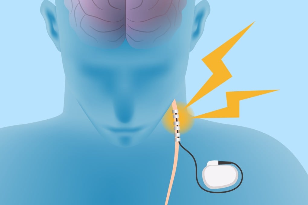 Invasive vagus nerve stimulation (VNS) uses a small device that is surgically implanted in the chest cavity near the collarbone to send electrical pulses to the vagus nerve which transmits those pulses to the brain.
Illustration: Shutterstock