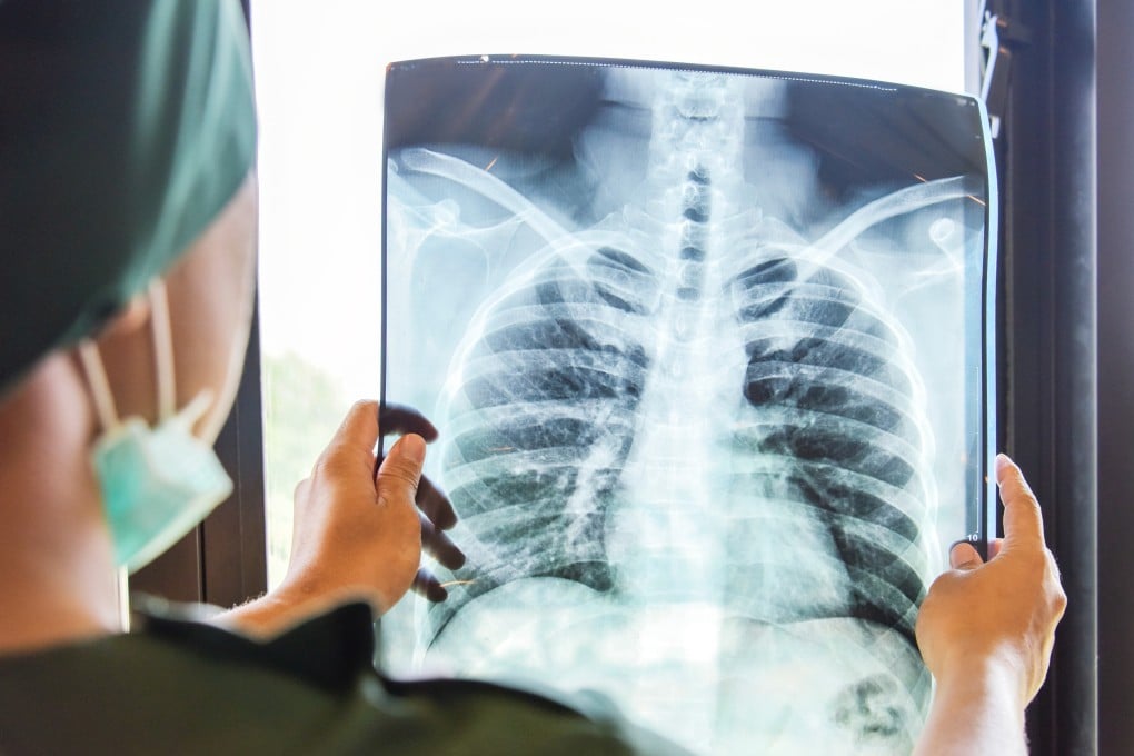 Sunvozertinib was granted breakthrough therapy designations from China’s National Medical Products Administration in 2020 and the US Food and Drug Administration in 2022. Photo: Shutterstock