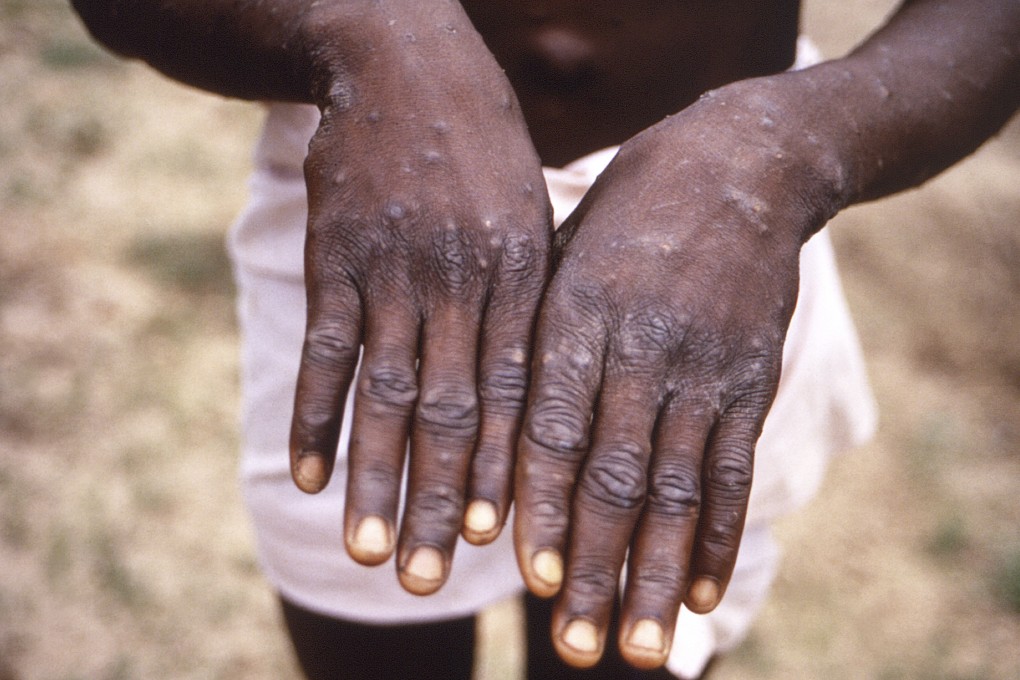 The characteristic rash of mpox is seen on the hands of a patient. As Congo copes with its biggest outbreak of mpox, scientists warn discrimination against gay and bisexual men on the continent could make it worse. File photo: CDC via AP