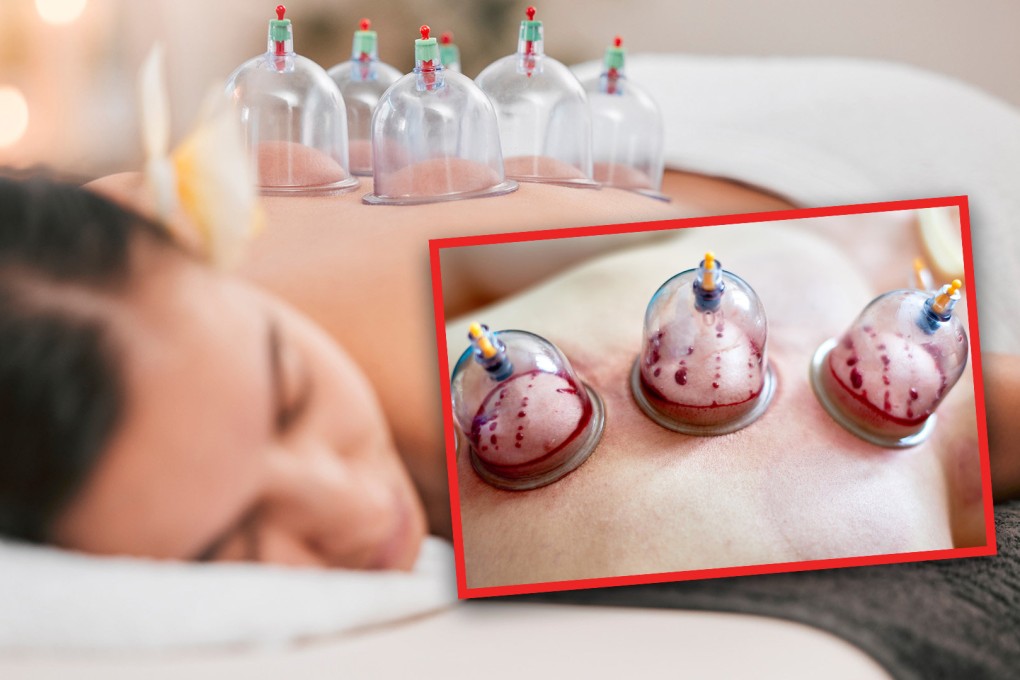 A woman in China had to be rushed to hospital suffering from severe anaemia due to the long term effects of two year’s worth of traditional bloodletting and cupping treatments. Photo: SCMP composite/Shutterstock