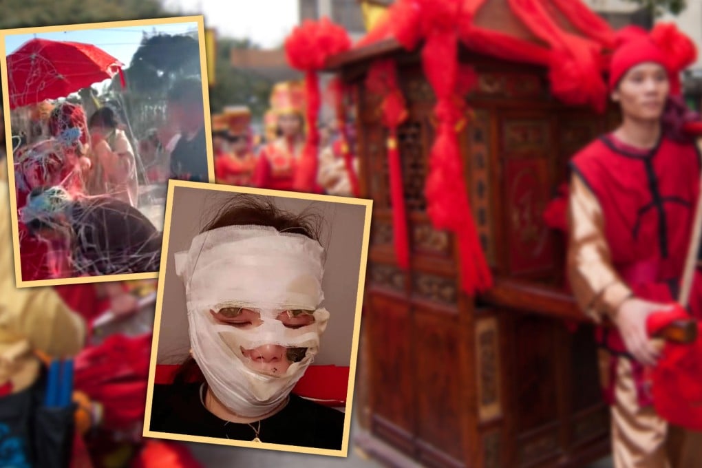A bride in China has been left with horrific facial injuries after being showered with flammable party streamers as she emerged from her wedding car. Photo: SCMP composite/Shutterstock/Douyin