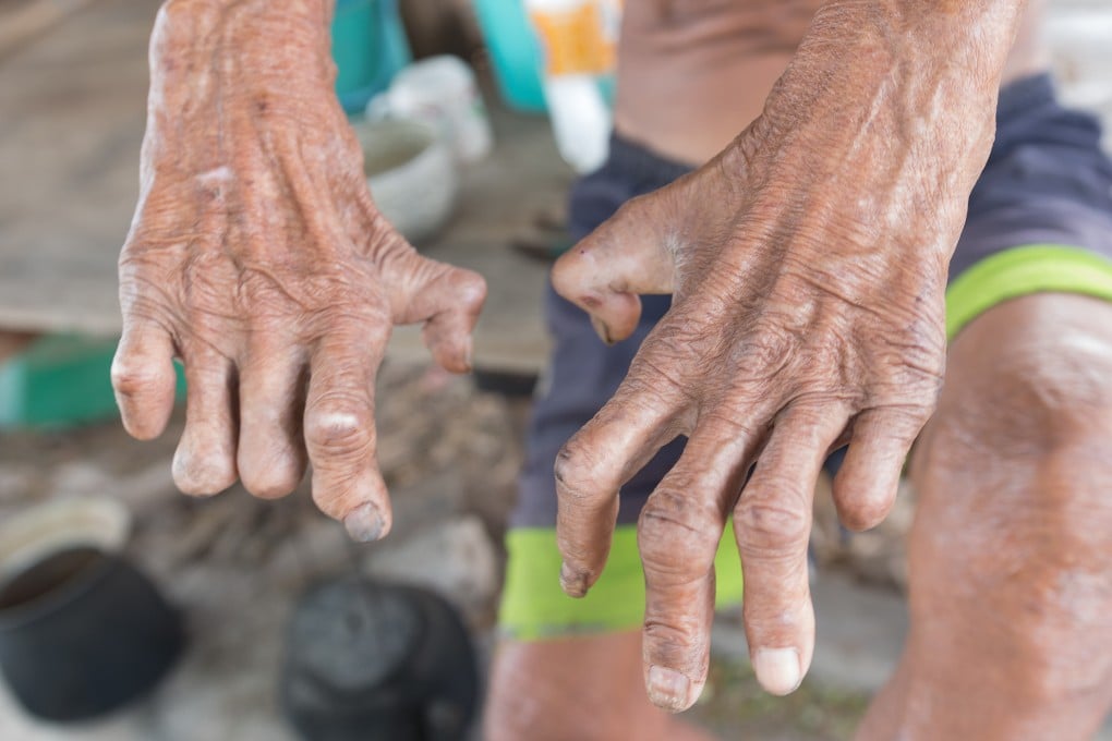 Leprosy, if untreated, can damage nerves, meaning a sufferer is less likely to react to pain, from burns, say, or pressure - which can destroy tissue. We look at the disease’s symptoms, treatment, transmission and stigma, and whether it’s contagious or curable. Photo: Shutterstock