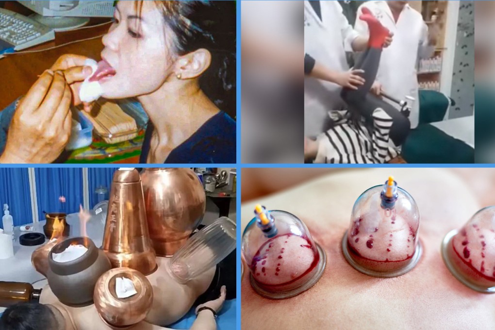 From tongue acupuncture to whacking bones with a hammer, traditional Chinese medicine treatments can appear outlandish. The Post guides you through four therapies that appear scary to the novice, but can provide cures for many ills. Photo: SCMP composite/Shutterstock/Douyin/QQ.com