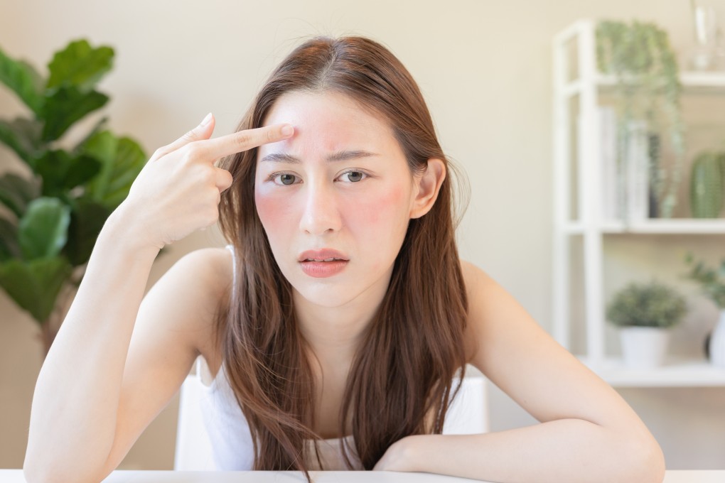 Autoimmune diseases including lupus (above, with its butterfly-shaped facial rash) affect far more women than men, and the answer could lie in women having two X chromosomes. Photo: Shutterstock