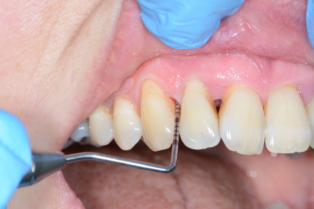 Bad dental hygiene could affect your mental health in the future, according to a study that says the risk of Alzheimer’s is 21 per cent higher in people with poor hygiene and gum disease. Photo: Professor Nicola West