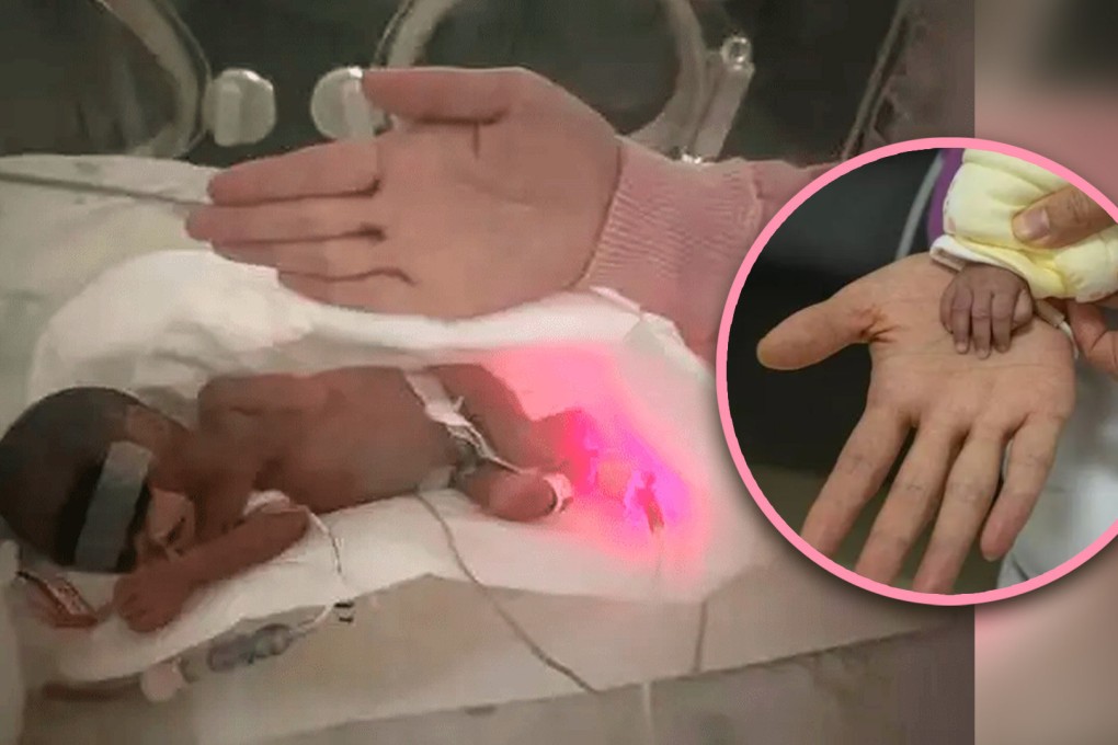 A premature baby girl in China, who was born no bigger than the size of an adult hand, has been discharged from hospital after 112 days of intensive care. Photo: SCMP composite/Baidu/Weibo