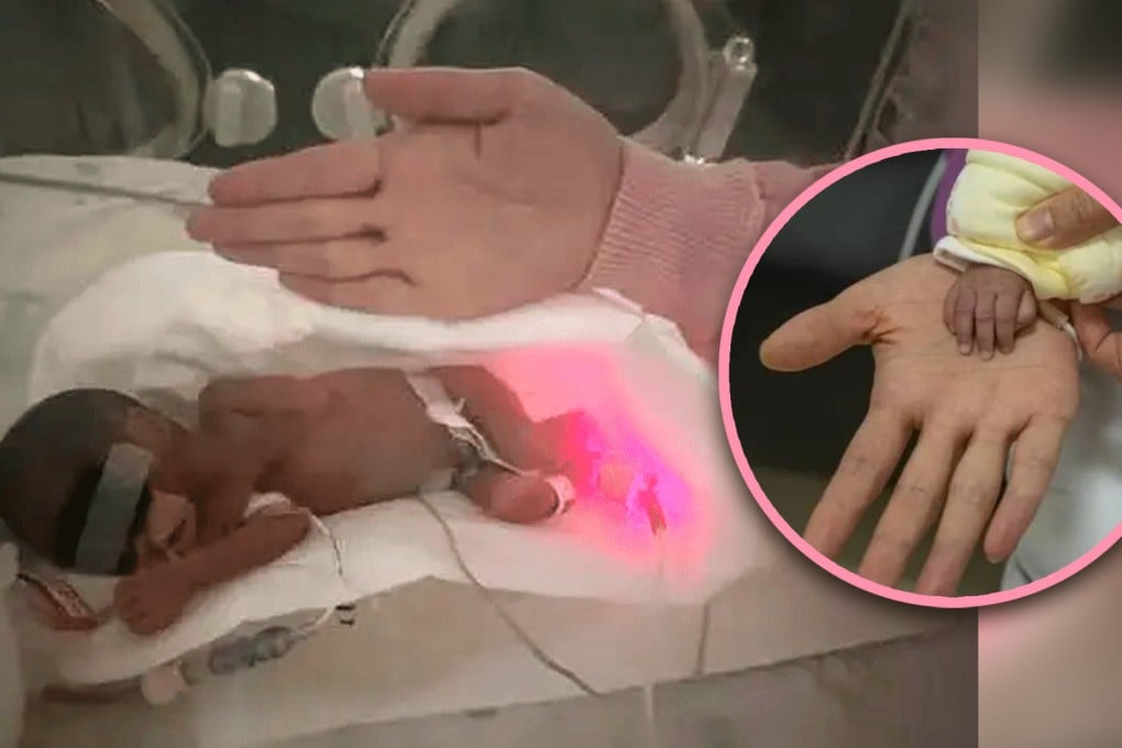 A premature baby girl in China, who was born no bigger than the size of an adult hand, has been discharged from hospital after 112 days of intensive care. Photo: SCMP composite/Baidu/Weibo