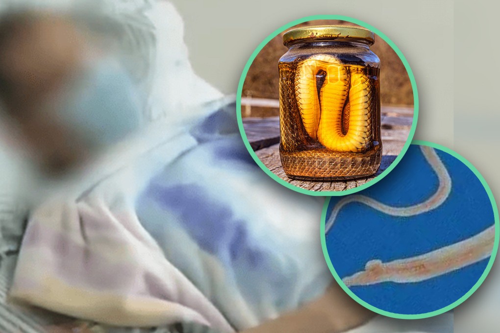 A mainland man who indulged in traditional Chinese medicine remedies involving snake parts 15 years ago has been found to have damaging parasites lodged inside his spinal cord. Photo: SCMP composite/Shutterstock/Weibo