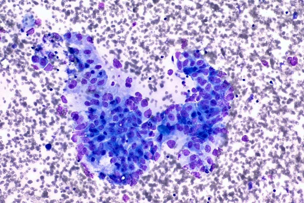 Chinese team’s findings “mark a new era in the precision diagnosis and treatment of pancreatic cancer”, says doctor commenting on the research. Photo: Shutterstock Images