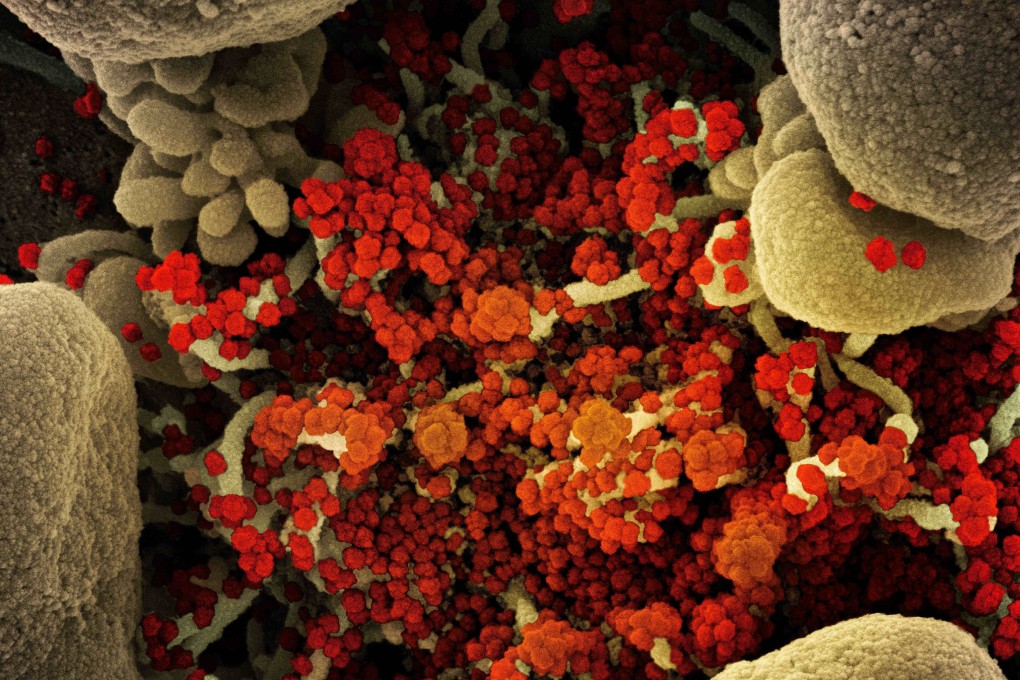 Coronavirus particles are seen in a scanning electron micrograph of a heavily infected cell. Image: NIAID via TNS