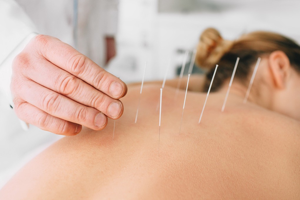 Acupuncture is the most common form of traditional Chinese medicine in use at Hong Kong hospitals. The city is taking steps to more fully integrate TCM into its healthcare system, but there are some challenges to overcome. Photo: Shutterstock