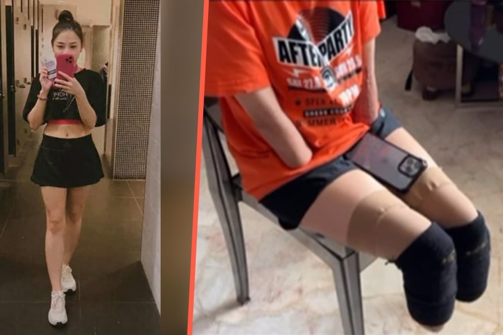 A Malaysian woman has had all her limbs amputated after a fever turned into a severe bacterial infection. Photo: SCMP composite/Shin Min Daily News