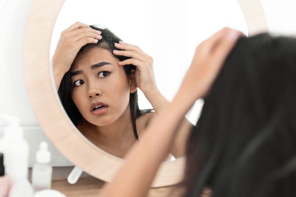 Hair issues afflict one in six people in China, and a new AI-powered feature on Alipay is promises to help people self-assess whether they are balding. Photo: Shutterstock