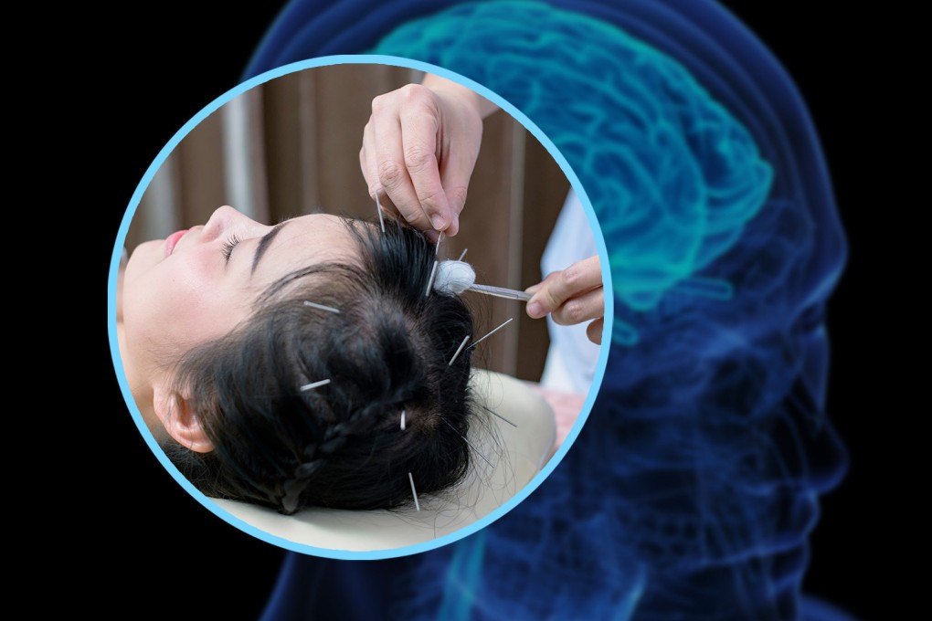 A clinic in China has claimed that it can boost the IQ of people by performing acupuncture on their heads. Photo: SCMP composite/Shutterstock