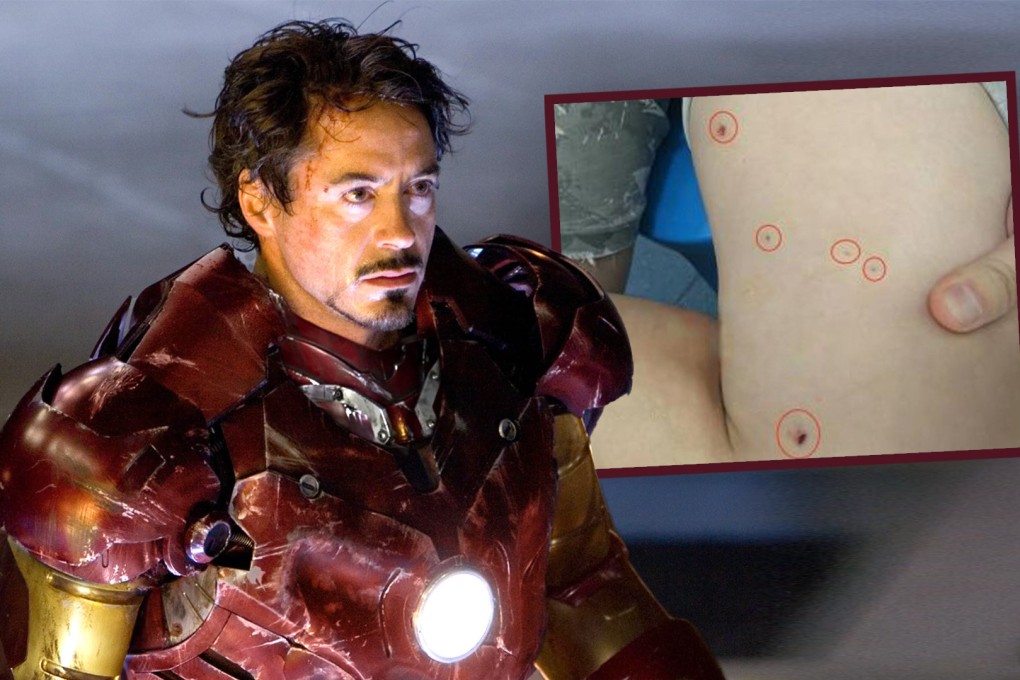 A blast victim in China ended up in hospital after he tried to copy his favourite superhero character, Iron Man, by using a magnet to extract metal shards from his thigh. Photo: SCMP composite/IMDb/Weibo