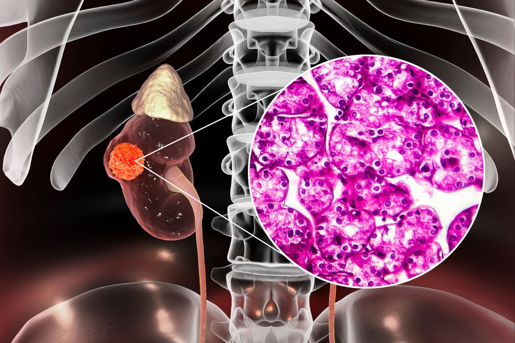 Many kidney cancer cases are discovered during routine check-ups or through CT scans done as investigations for other complaints. Patients who have symptoms usually have poorer outcomes, since symptoms do not usually occur until the disease is advanced. Illustration: Shutterstock
