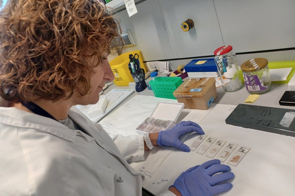 New dementia research found that people with two copies of the APOE4 gene, one inherited from each parent, will almost certainly develop the biological signs of Alzheimer’s disease. Photo: Hospital de la Santa Creu i Sant Paul