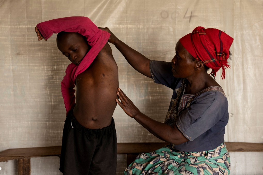 Fideline Kiza Kasao checks the progress of her son Kito Balume after his recovery from mpox outside their shelter at the Muja displaced persons camp in Nyiragongo territory near Goma, North Kivu province in the Democratic Republic of the Congo in July. Photo: Reuters