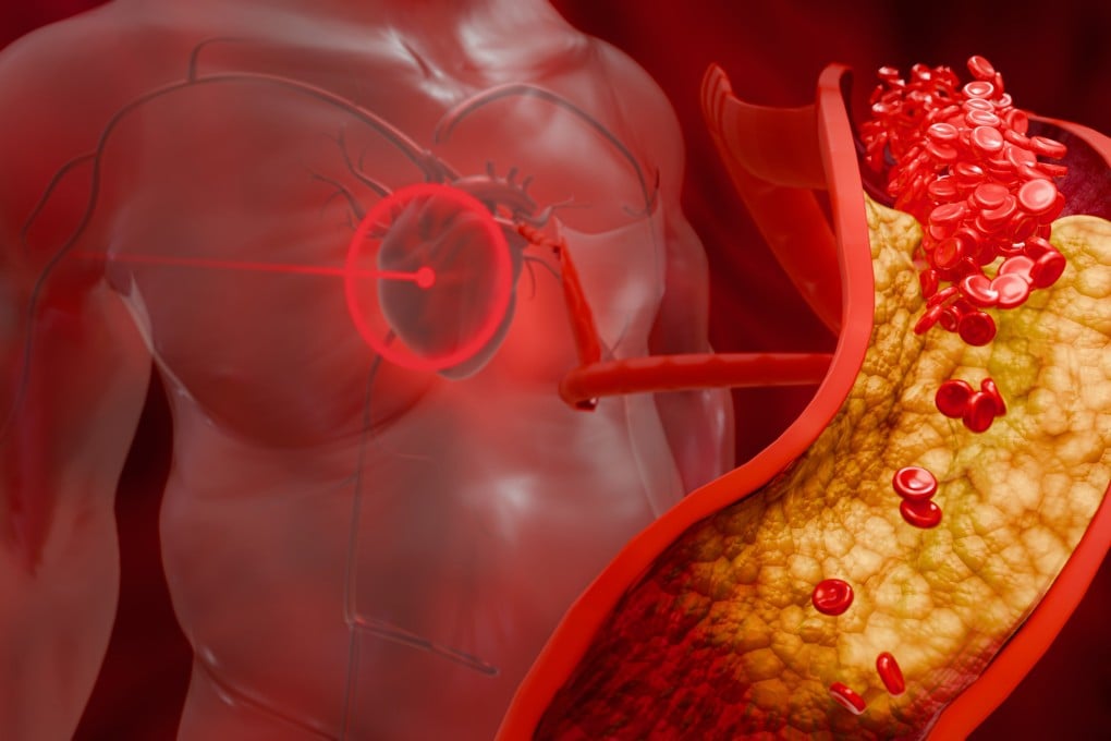 High low-density lipoprotein (LDL) cholesterol can build up in arteries and clog them, causing problems for the brain as well as the heart. Illustration: Shutterstock