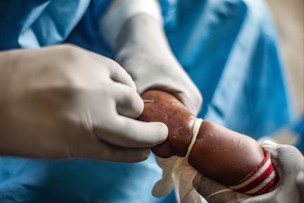 A child with mpox gets treatment at a hospital near Goma, North Kivu province, Democratic Republic of the Congo. Photo: Xinhua