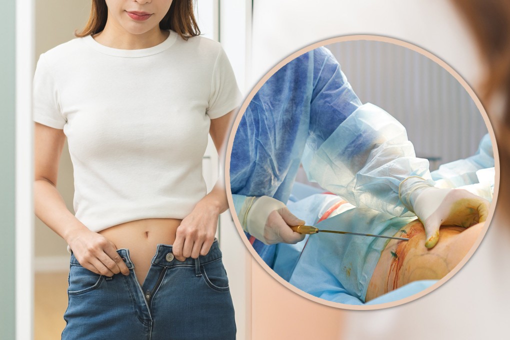 A 50-kg Chinese woman who had liposuction to remove a “little belly” has been left infertile as a result. Photo; SCMP composite/Shutterstock